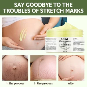 Body Shea Butter Stretch Mark Cream Obesity Body Line Care Cream Firming Nourishing Fading Postpartum Stretch Mark Repair Cream