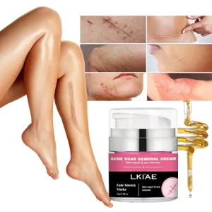 Fast Fade Stretch Marks Anti Spots Scar Mark Removal Cream Stretch Marks Repair Acne Correct Body Care Cream