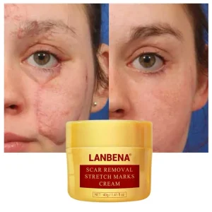 Lanbena Stretch Mark Acne Scar Removal Cream Skin Repair Moisturizer Vitamin C Aloe Vera Vegan Organic Scar Cream