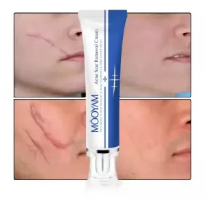 Scar Removal Cream Strong Effective Acne Pimples Stretch Marks Face Gel Tummy Tuck Tightening Stretch Mark Removal Cream 30g