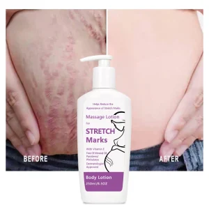 Scar Remover Cream Effective Deep Acne Scar for Legs and Thighs for Female Stretch Mark Cream Set