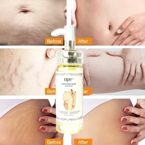 Scar Repair & Stretch Marks Removal Oil Smooth Skin Deep Moistening Fast Absorbing Non Greasy Bulk Supply