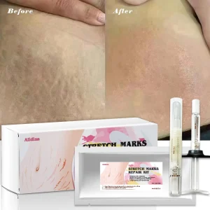 Skin Fading Pimple Mark Stretch Marks Scar Fade Cream for Powerful Repair for Postpartum Use