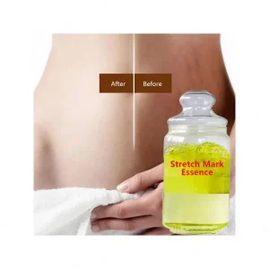 Stretchmark Repair Scar Cream Pregcy Abdomen Anti Vergeture Organic Shea Butter Stretch Mark Removal Cream