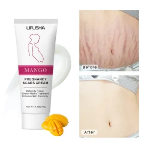 Tax Free Strong Effective Scar Stretch Mark Cream Skin Care Products Massage Repair Remover Cream Stretch Mark Removal